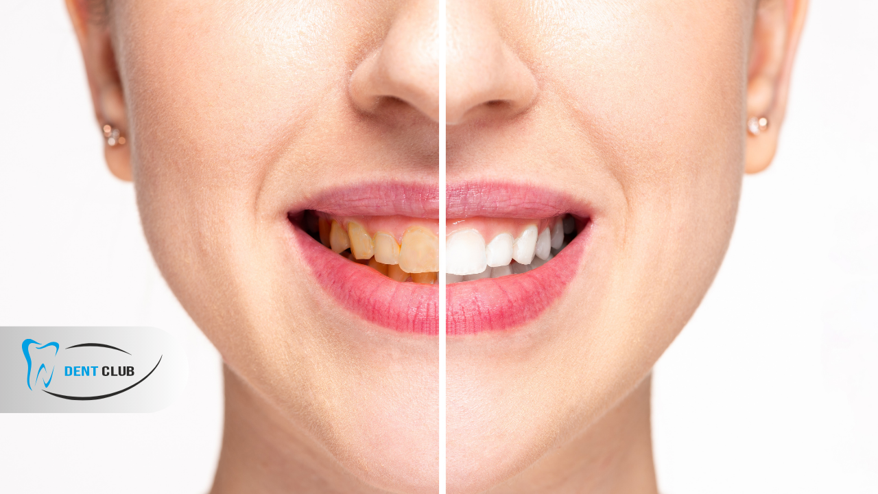 Diş Lekeleri Daha Parlak Bir Gülüş İçin Doğal Çözümler